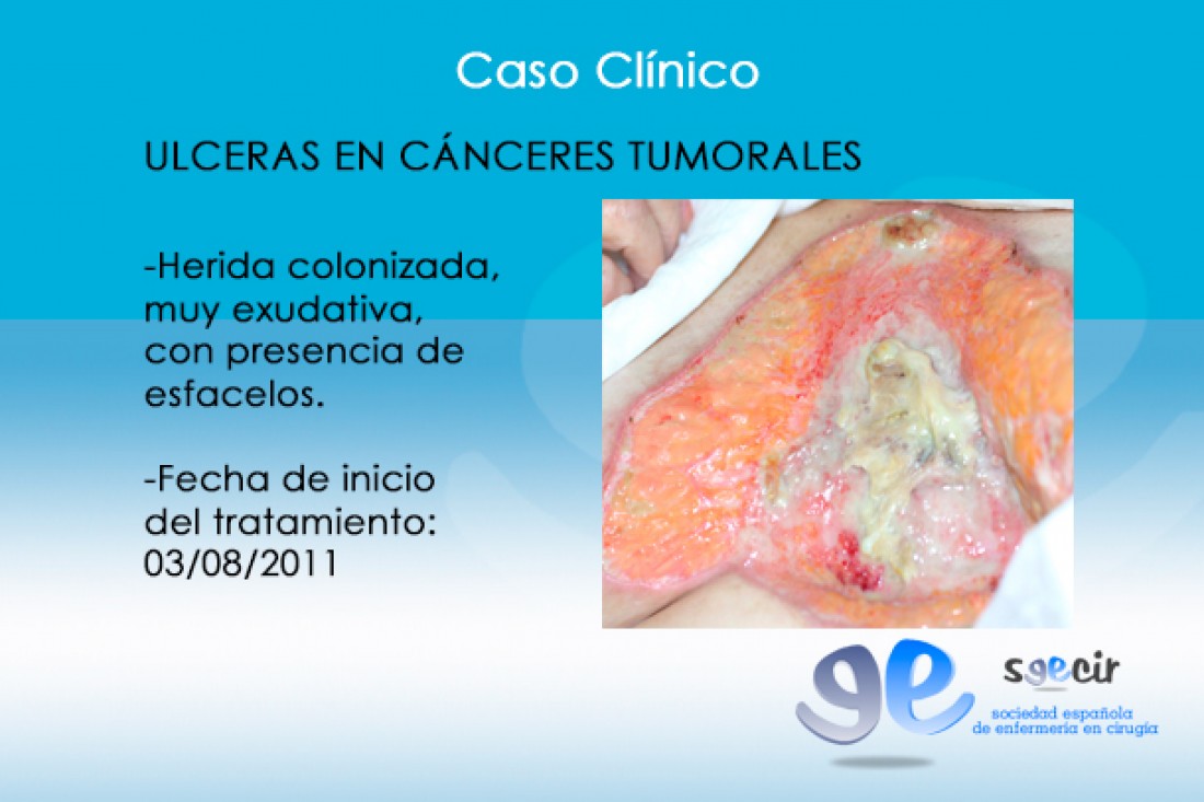 CraUlceraTumoral-07